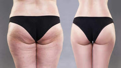 Gastric bypass surgery - What to expect