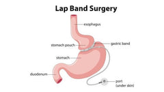 Lap Band Surgery Cost, Risk, and Diet Before and After The Procedure